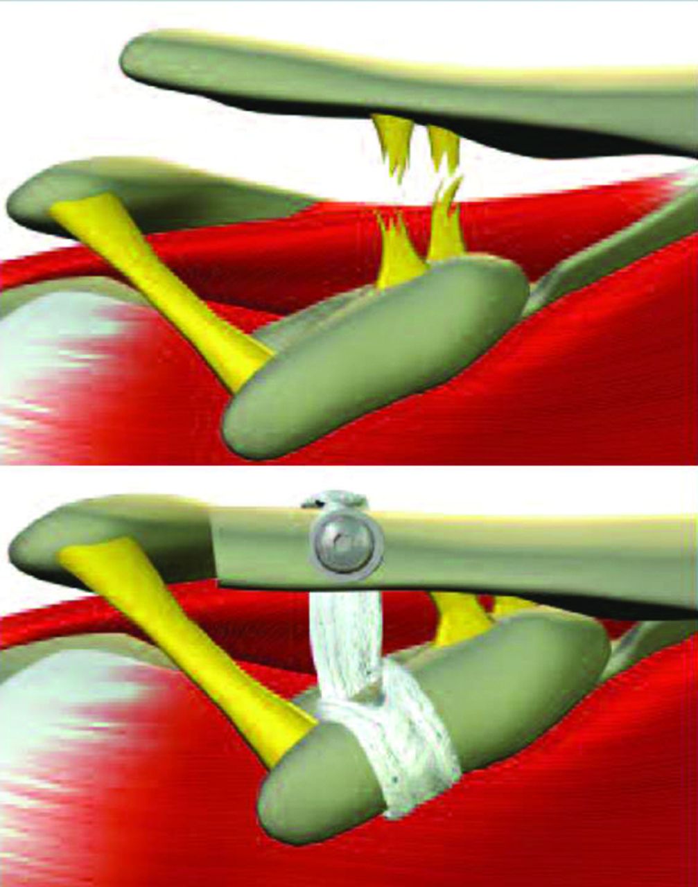 Fig. 10 
          Nottingham Surgilig (now called LockDown) for stabilising the Acromio-Clavicular Joint (previously Surgicraft now Mandaco 569 Ltd 1995)
        