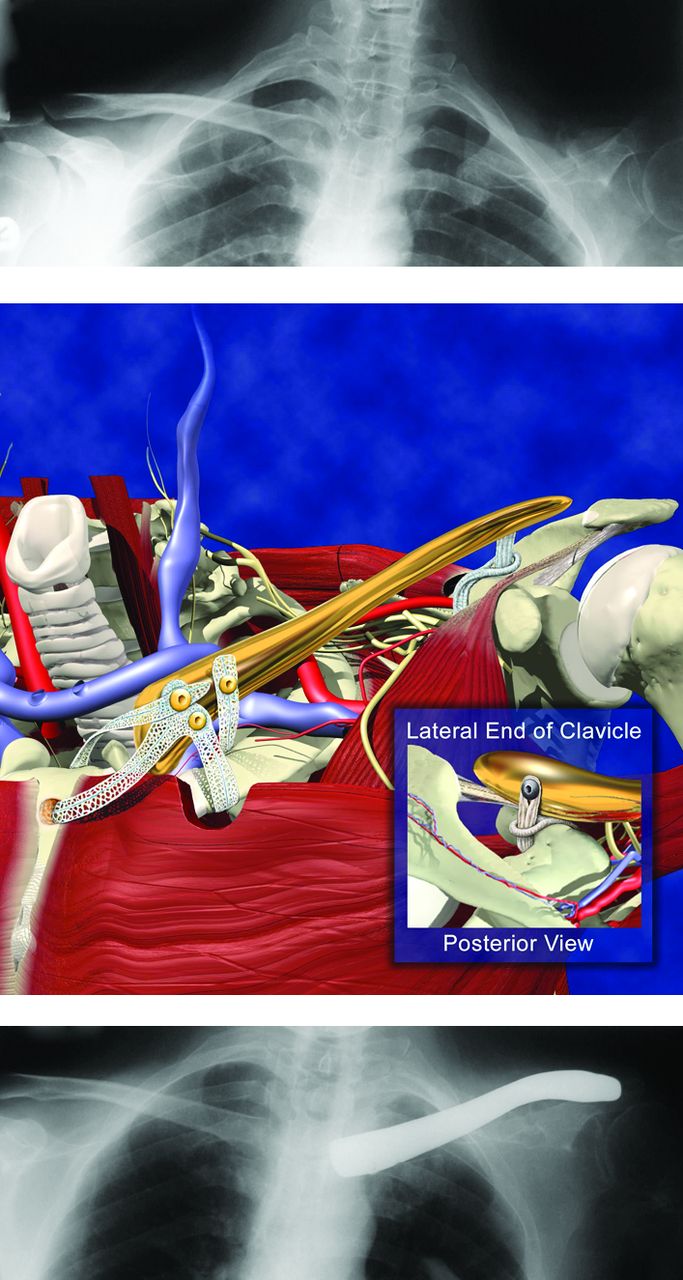 Fig. 15 
          Probably the World's First Claviculoplasty (clavical replacement) (Biomet 2003)
        