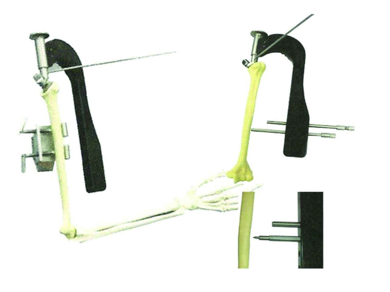 Fig. 5 
          Nottingham Inter-Locking Stem (ILS) prosthesis (Biomet 2004).
        