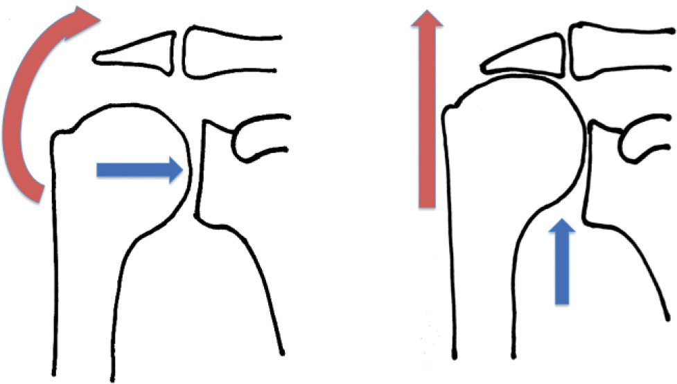 Fig. 1 
          Proximal migration in cuff tear arthropathy with resulting deltoid dysfunction- schematic
        