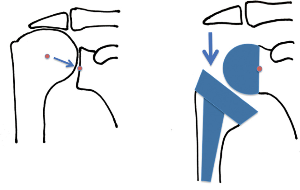 Fig. 2 
          Medialisation of centre of rotation in reverse shoulder arthroplasty- schematic
        