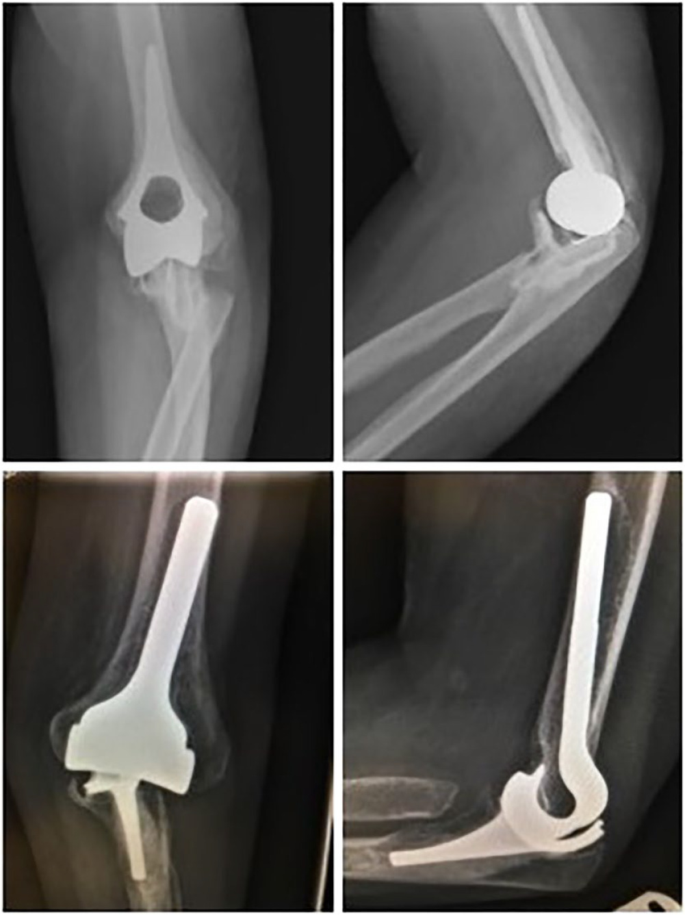 Fig. 4 
            Radiographs presenting two commonly used unlinked prostheses in the past: Souter-Strathclyde (top) and Kudo (bottom).
          