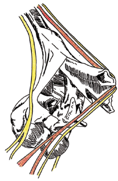 Fig. 1 
        Pathoanatomy of a posterolaterally displaced Gartland III extension-type supracondylar fracture. Illustration courtesy of Mr A. Faulkner.
      