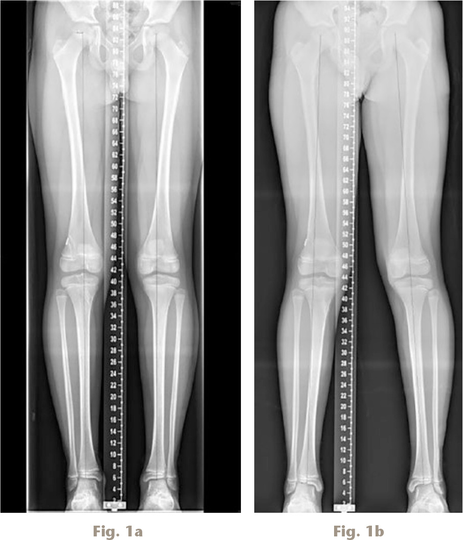 Fig. 1 
          a) and b) Valgus deformity of right femur following anterior cruciate ligament (ACL) reconstruction.
        