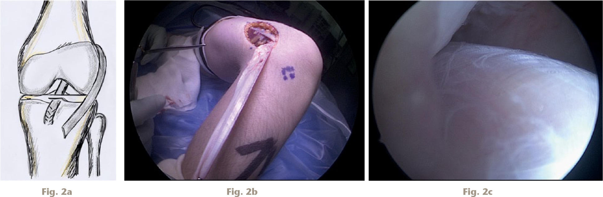 Fig. 2 
          a) Extra-articular reconstruction, b) harvesting of iliotibial band (ITB), and c) ITB graft in situ entering posterior to femoral condyle.
        
