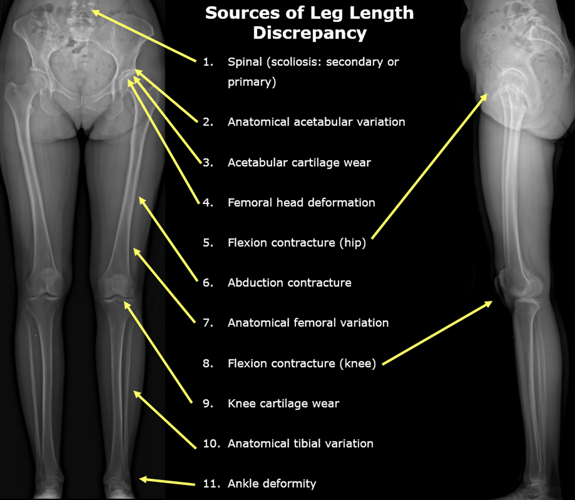 Fig. 1 
          Example long-limb EOS imaging to highlight the many different potential sources of leg length discrepancy.
        