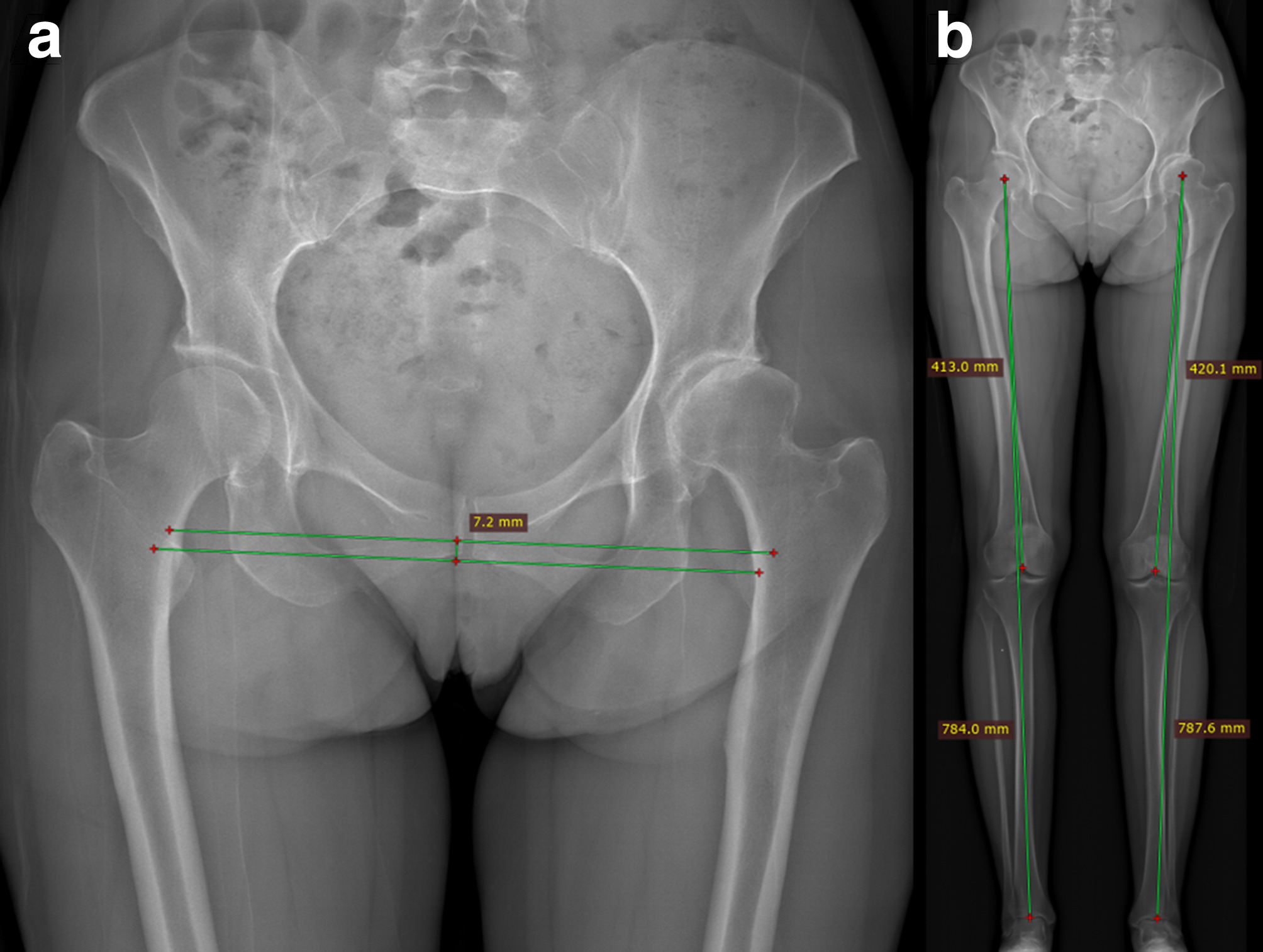 Fig. 5 
          EOS imaging from a patient 49-year-old female who underwent total hip arthroplasty. On the left is a zoomed-in recreation of a standing anteroposterior radiograph from the EOS. On the right is the full EOS image of the long leg alignment.
        