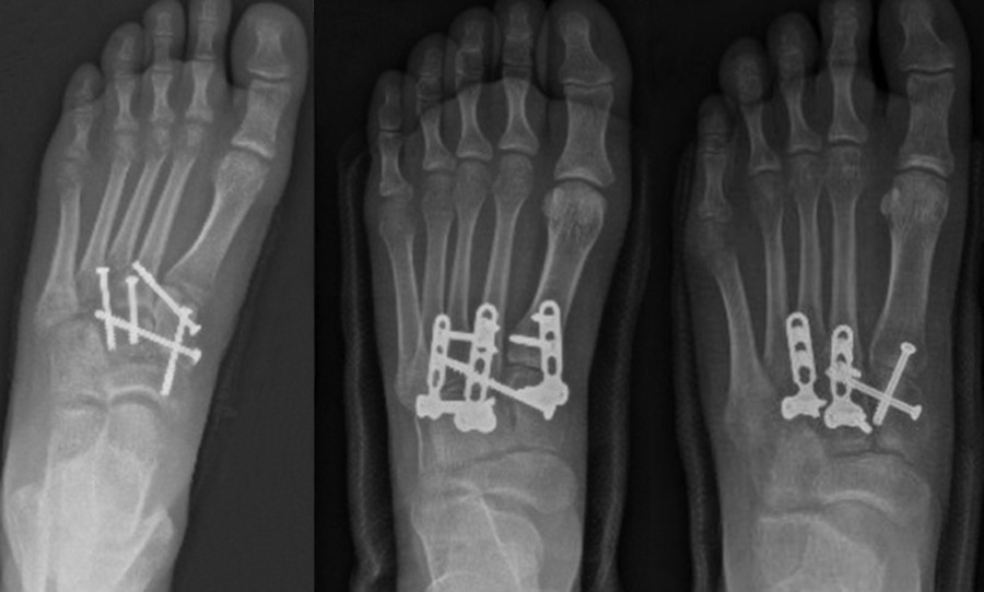 Fig. 1 
          Radiograph of a foot from the transarticular
screw group, a foot from the bridge plate group, and a foot from
the combination group.
        