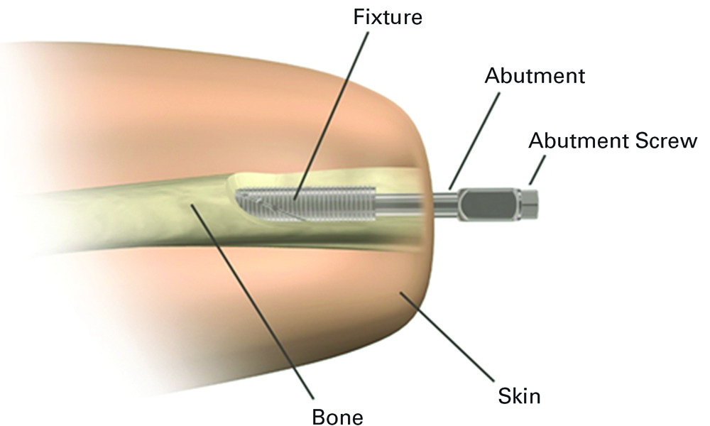 Fig. 1 
        The Osseointegrated Prostheses
for the Rehabilitation of Amputees (OPRA) Implant System. It includes
three main parts: an implanted fixture, an abutment, and an abutment
screw. The fixture is implanted into the residual bone at a first operation.
At a second operation, about six months later, the percutaneous
parts, (the abutment and screw), are installed into the fixture
to act as the connection to the artificial limb. These two components
can be replaced if needed. The second operation also involves the
creation of the percutaneous area where the implant protrudes from
the residual limb. This figure is reproduced with permission from Brånemark
R, Berlin O, Hagberg K, et al. A novel osseointegrated percutaneous
prosthetic system for the treatment of patients with transfemoral
amputation: A prospective study of 51 patients. Bone Joint
J 2014;96-B:106-113.
      