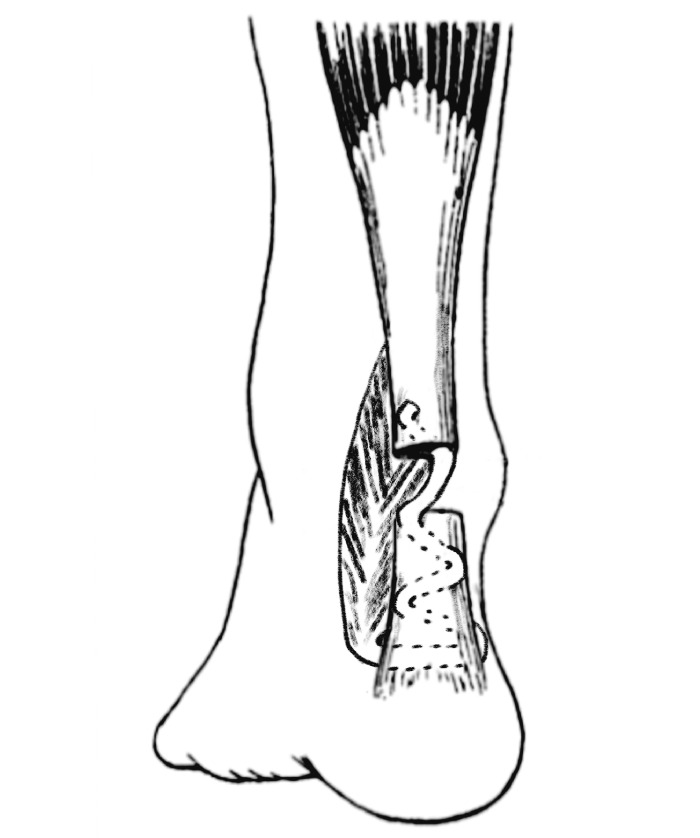 The Functional And Dynamometer Tested Results Of Transtendinous Flexor Hallucis Longus Transfer