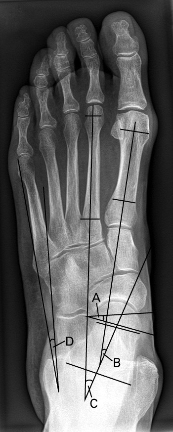 The inter- and intraobserver reliability for the radiological ...