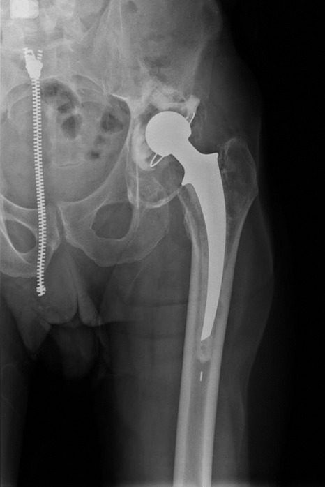 Two-centre Radiological Survivorship Of Acetabular Distraction ...