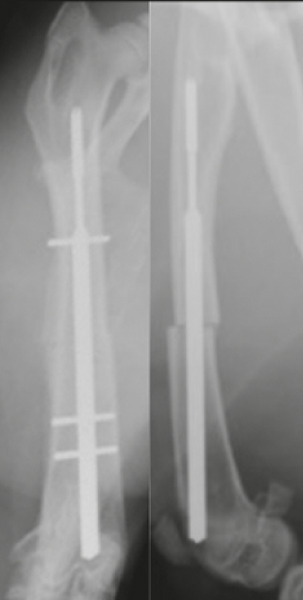 Figs. 1a - 1b 
          Anteroposterior and lateral radiographs
taken a) postoperatively and b) at eight weeks showing the osteotomy, intramedullary
nail, locking pins and development of callus.
        