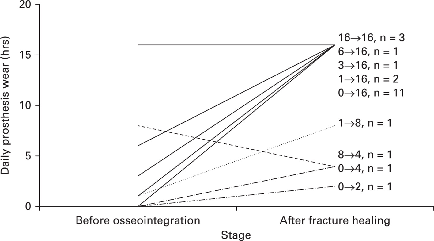 Fig. 3 
          The amount of time patients reported wearing their prosthesis is shown before osseointegration and after the care of their fracture was complete. Numerical labels represent pre-osseointegration hours → current post-fracture hours, number of patients in this grouping. Notable points: 1) among patients who sustained a fracture, 18/22 (81.8%) wear their prosthesis for ≥ 16 hours/day; and 2) the number of hours before osseointegration and after fracture care declined in only one patient.
        