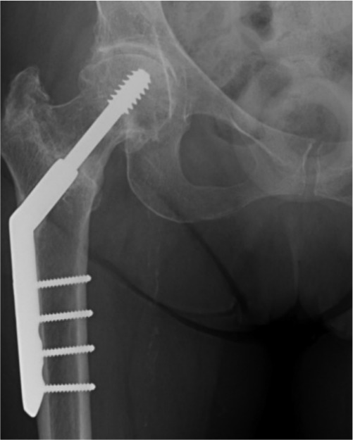 Fig. 1 
          Anteroposterior radiograph of sliding hip screw fixation of a right trochanteric fracture.
        