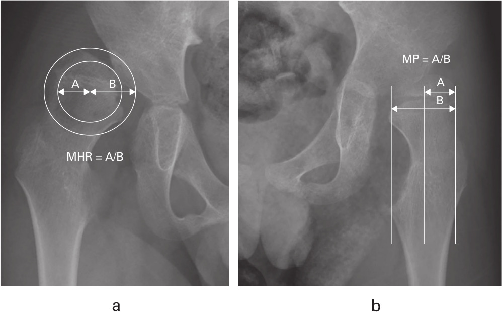 Fig. 2 
            Anteroposterior (AP) hip supine radiographs of an eight-year-old male patient. a) On the right hip, the Mose hip ratio (MHR) was defined as the percentage ratio between radii of two concentric circles (the inner A) and outer cortices (B) of femoral head ). b) On the left hip, the migration percentage (MP) was calculated by dividing the width of the femoral head lateral to the Perkin’s line (A) by the total width of the femoral head (B).
          