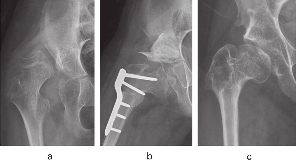 Fig. 3 
          Radiographs of an 11-year-old female patient with Gross Motor Function Classification System level V who underwent hip reconstructive surgery (HRS) because of bilateral cerebral palsy (CP) hip displacement. a) Preoperative radiograph of the right hip shows the migration percentage (MP) (100%) and Mose Hip Ratio (MHR) (64%), along with head destruction. b) Immediate postoperative radiograph after HRS consisting of bilateral open reduction, femoral varization and derotational osteotomy, Dega osteotomy, and soft tissue release. c) Radiograph at last follow-up (four years after HRS). Head deformity has improved to a MHR of 71% and MP of 13%. The patient is currently pain-free.
        