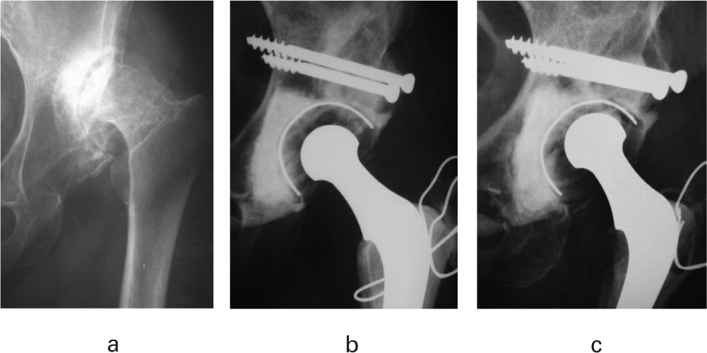 Fig. 3 
          Radiographs of a 57-year-old female a) preoperatively, b) three months postoperatively, and c) 33 years postoperatively.
        