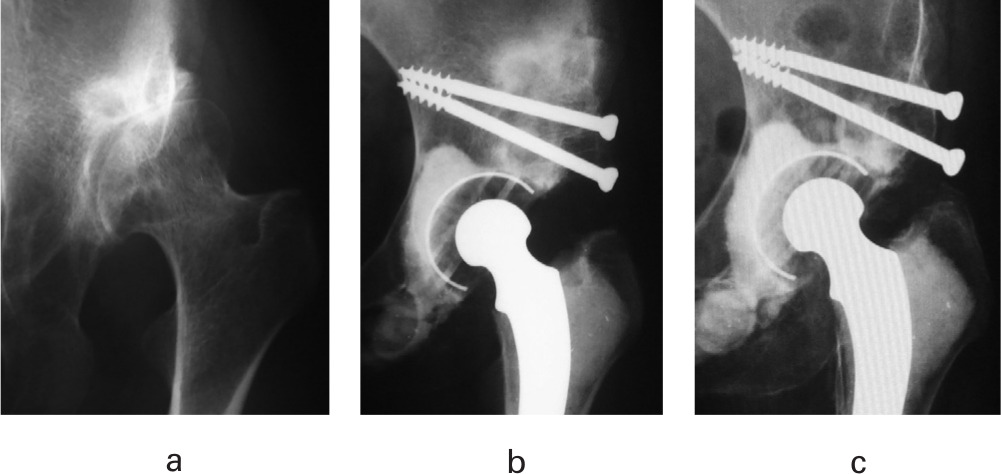 Fig. 4 
          Radiographs of a 44-year-old female a) preoperatively, b) two months postoperatively, and c) 32 years postoperatively.
        