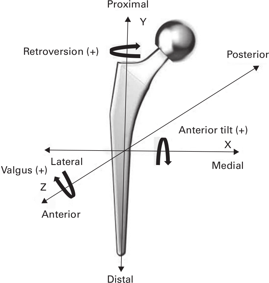Fig. 2 
          Orientation of the migration coordinate system with the Corail stem (DePuy Synthes, USA).
        