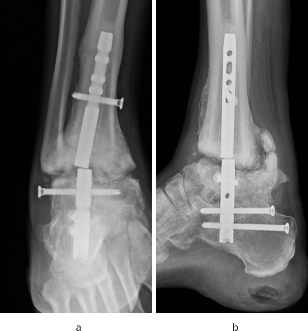 Predictors of metalwork failure and nonunion after hindfoot Charcot  reconstruction | Bone & Joint