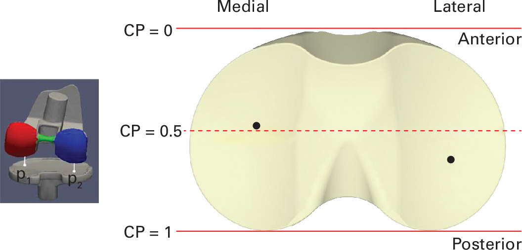 Fig. 2 
            Definition of femorotibial contact point (CP) was the minimal distance location between femur and tibia components. This CP is reported as a ratio from 0 to 1, representing respectively the most anterior and most posterior rims of the tibial inserts.
          