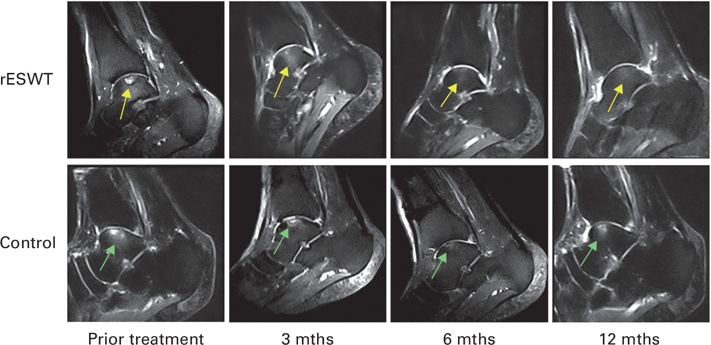 Fig. 2 
          MRI images showing the changes in bone marrow oedema in the rESWT and control groups. Yellow and green arrows indicate areas of bone marrow oedema.
        