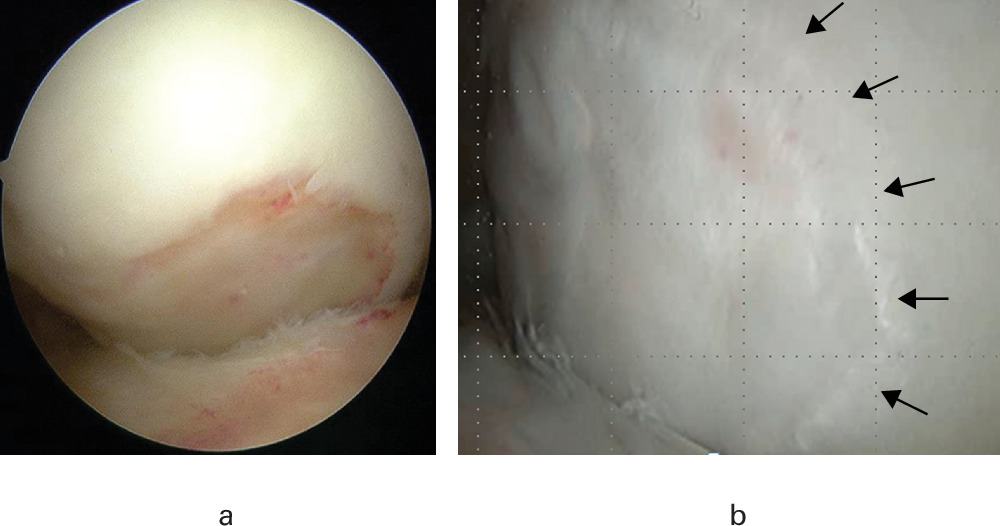Fig. 3 
            Representative arthroscopic findings. Arthroscopic image a) before ultra-purified alginate implantation and b) during second-look arthroscopy 72 weeks postoperatively. The defects were covered with regenerative cartilage-like tissue at 72 weeks. Arrows indicate the border between regenerating and healthy cartilage.
          