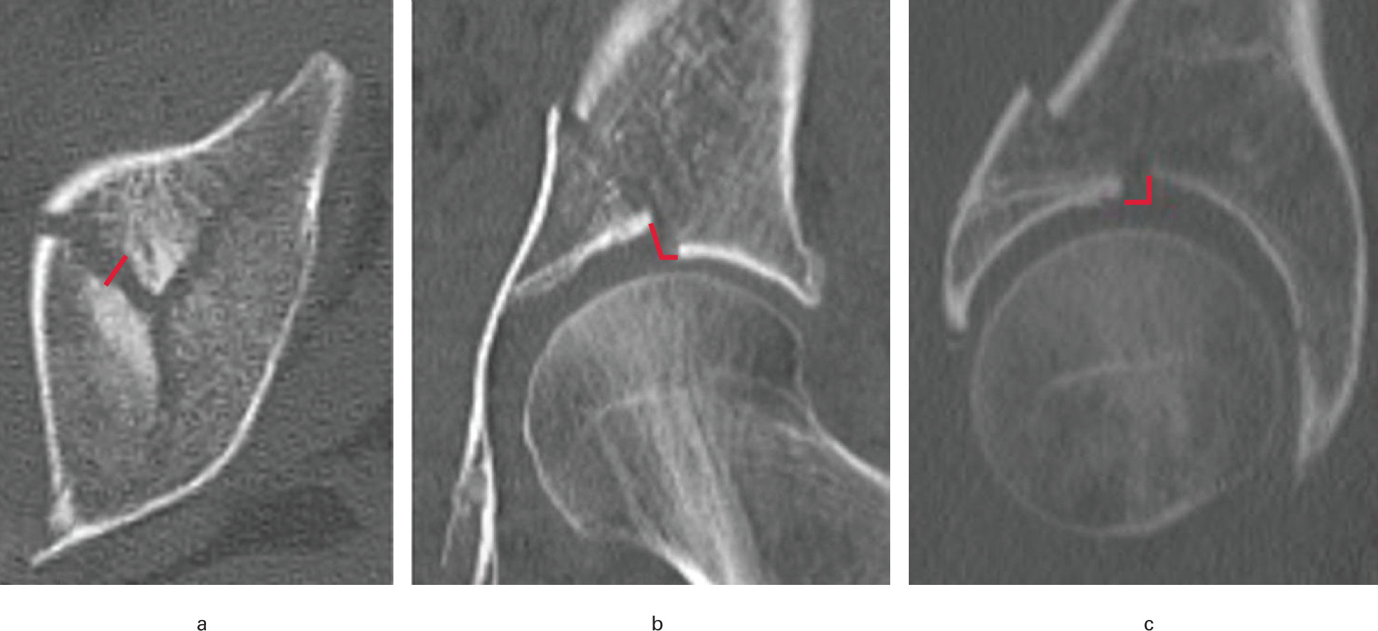 Fig. 1 
            Measurements of the acetabular fracture displacement of a 68-year-old woman are displayed in the a) axial (gap 4 mm), b) coronal (step-off 4 mm, gap 2 mm), and c) sagittal (step-off 3 mm, gap 3 mm) views.
          