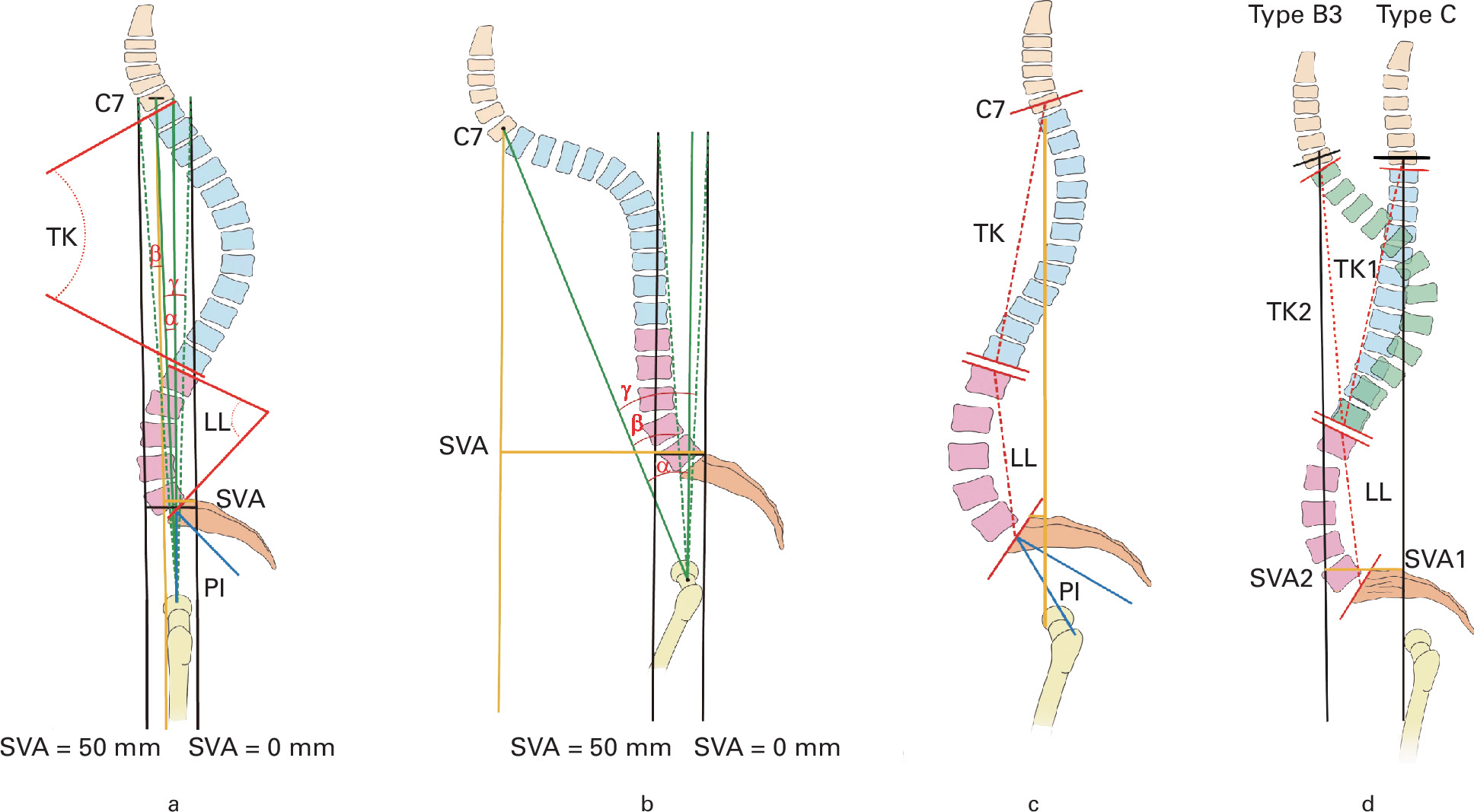 Fig. 2 
          Schematic drawing of definitions for the classification of the patients and for the parameters of the prediction of the standing pelvic tilt (PT). a) Definitions of the key parameters for the parameters of the classification on the lateral view. The sagittal vertical axis (SVA) was defined as the distance from the upper corner of the S1 endplate to a vertical line from the centre of the body of C7 as the indicator of sagittal balance with a normal range of 0 mm to 50 mm. Pelvic tilt was defined as the angle subtended by a vertical line and the line connecting the centres of both hips and the midpoint of the superior endplate of S1, and PI was defined as the angle subtended by this line and the line perpendicular to the S1 endplate. Lumbar lordosis (LL) was defined as the Cobb angle between the upper endplate of L1 and the upper endplate of S1. Thoracic kyphosis (TK) was defined as the Cobb angle between the upper endplate of T1 and the lower endplate of T12. b) SVA-driven method predicts the change of pelvic tilt by assuming the spine to be a solid body for type A, B1, B2, and B3 patients. This change was predicted as the angle of the centre of C7 shifting from the preoperative C7 plumb line to the vertical line (α angle) over the predicted centre of the hip with SVA = 50 mm and 0 mm vertical lines as the lower (β angle) and upper (γ angle) limits of prediction, respectively. c) LL-driven method for predicting the change for type C patients. d) Effect of the LL-TK mismatch on the sagittal balance, leading to hyperextension of the spine (blue contour) and a negative SVA in type C patients and a balanced spinal curvature (green contour) in type B3 patients.
        