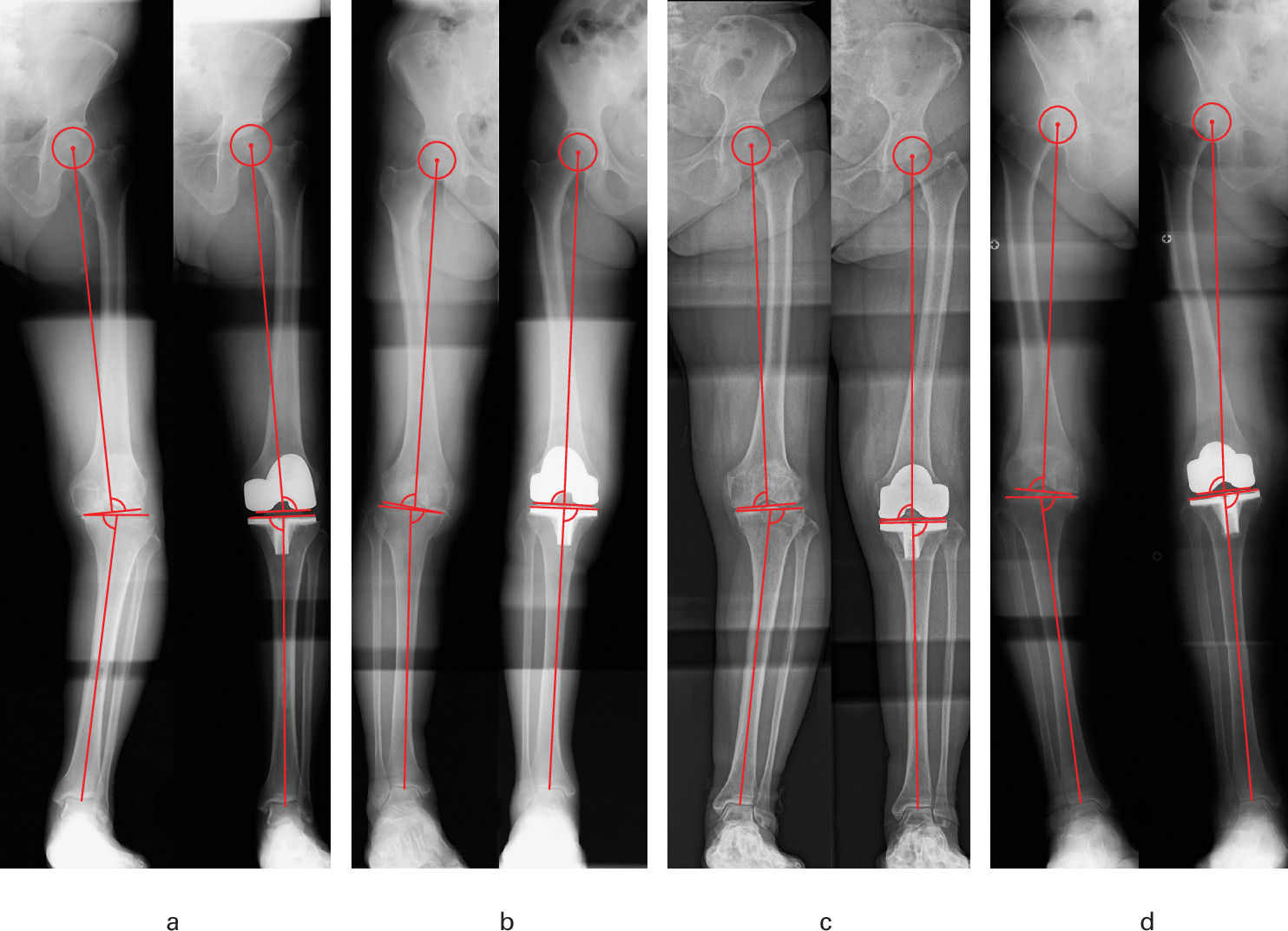 Fig. 5 
          Pre- and postoperative weightbearing anteroposterior full-leg radiographs of representative cases. a) Preoperative Coronal Plane Alignment of the Knee (CPAK) classification: phenotype I (varus/apex distal); postoperative CPAK classification: phenotype IV (varus/neutral). This case did not show any negative factors, including change in pre- to postoperative arithmetic hip-knee-ankle angle (aHKA) classification or postoperative apex proximal joint line obliquity (JLO). b) Preoperative CPAK classification: phenotype II (neutral/apex distal); postoperative CPAK classification: phenotype V (neutral/neutral). This case did not show any negative factors, including change in pre- to postoperative aHKA classification or postoperative apex proximal JLO. c) Preoperative CPAK classification: phenotype I (varus/apex distal); postoperative CPAK classification: phenotype V (neutral/neutral). This case showed a negative factor: change in pre- to postoperative aHKA classification. d) Preoperative CPAK classification: phenotype I (varus/apex distal); postoperative CPAK classification: phenotype VII (varus/apex proximal). This case showed a negative factor: postoperative apex proximal JLO.
        