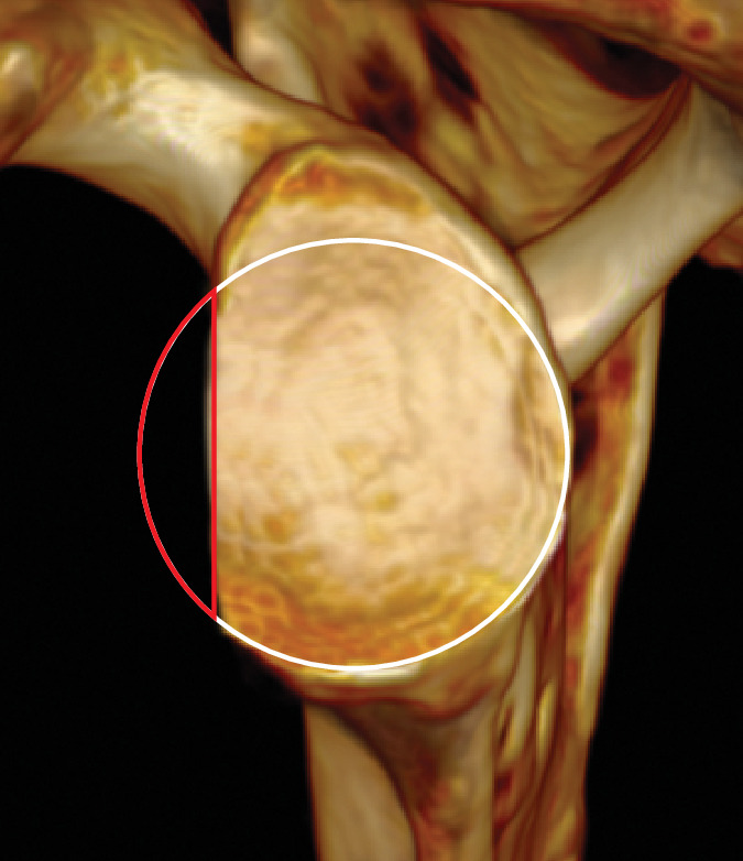 Fig. 2 
            Bone loss measured using the glenoid defect area method in which the area of the defect (red area) is divided by the area of the full circle (white circle) to achieve a percentage.
          