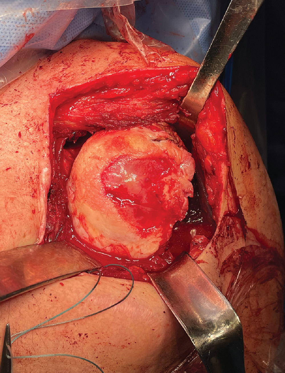 Fig. 5 
            Intraoperative image showing the humeral head erosion from screw impingement after a Latarjet procedure. This case was revised to a hemiarthroplasty.
          