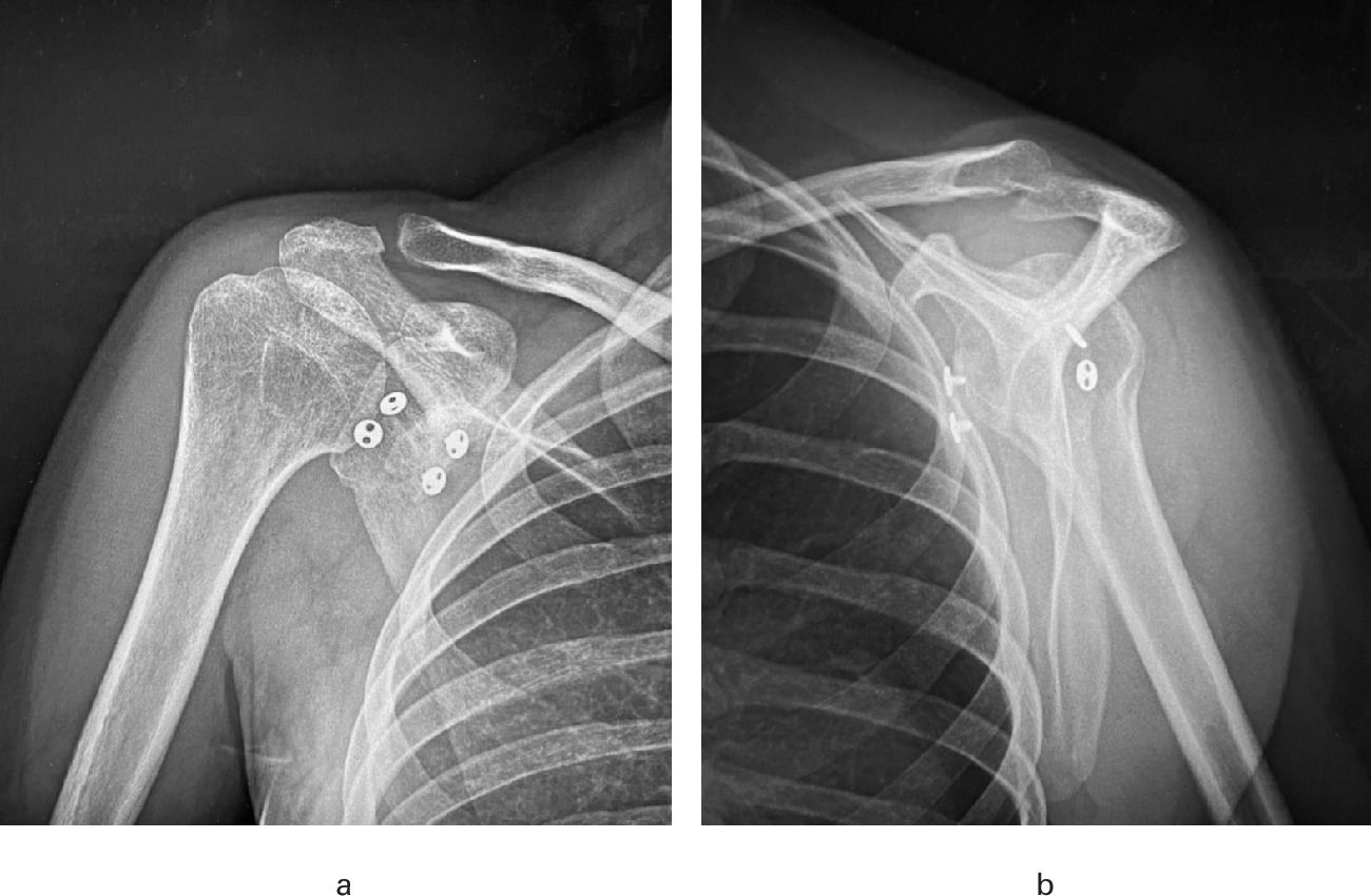 Fig. 7 
            a) Anteroposterior and b) sagittal radiograph of a right shoulder showing a bone block procedure with double endobutton fixation.
          