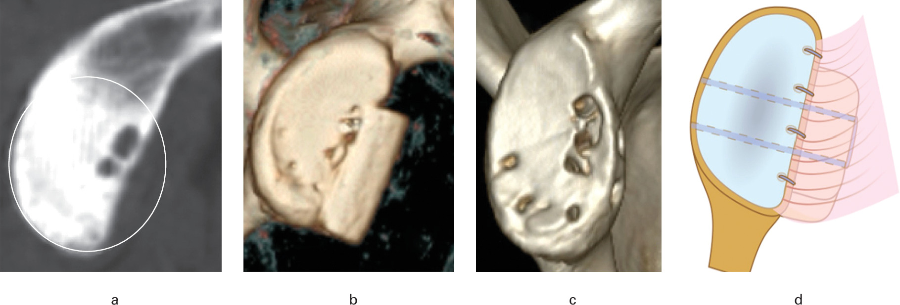 Fig. 8 
            a) The preoperative sagittal view of a CT-2D image of a shoulder with anterior instability and a significant bone defect is shown. The best-fit circle is calculated using a circle encompassing the two points tangential to the glenoid’s most posterior and inferior border. An “en-face” 3D CT image without the humeral head of a case using a free bone block cerclage. b) Immediate postoperative imaging. c) Result at two years after reconstruction with iliac crest allograft showing global remodeling with the restoration of the glenoid area. d) Illustrative drawing of the bone block cerclage technique to reconstruct the bone defect in anterior shoulder instability with the iliac crest graft and capsule-labrum repair.
          