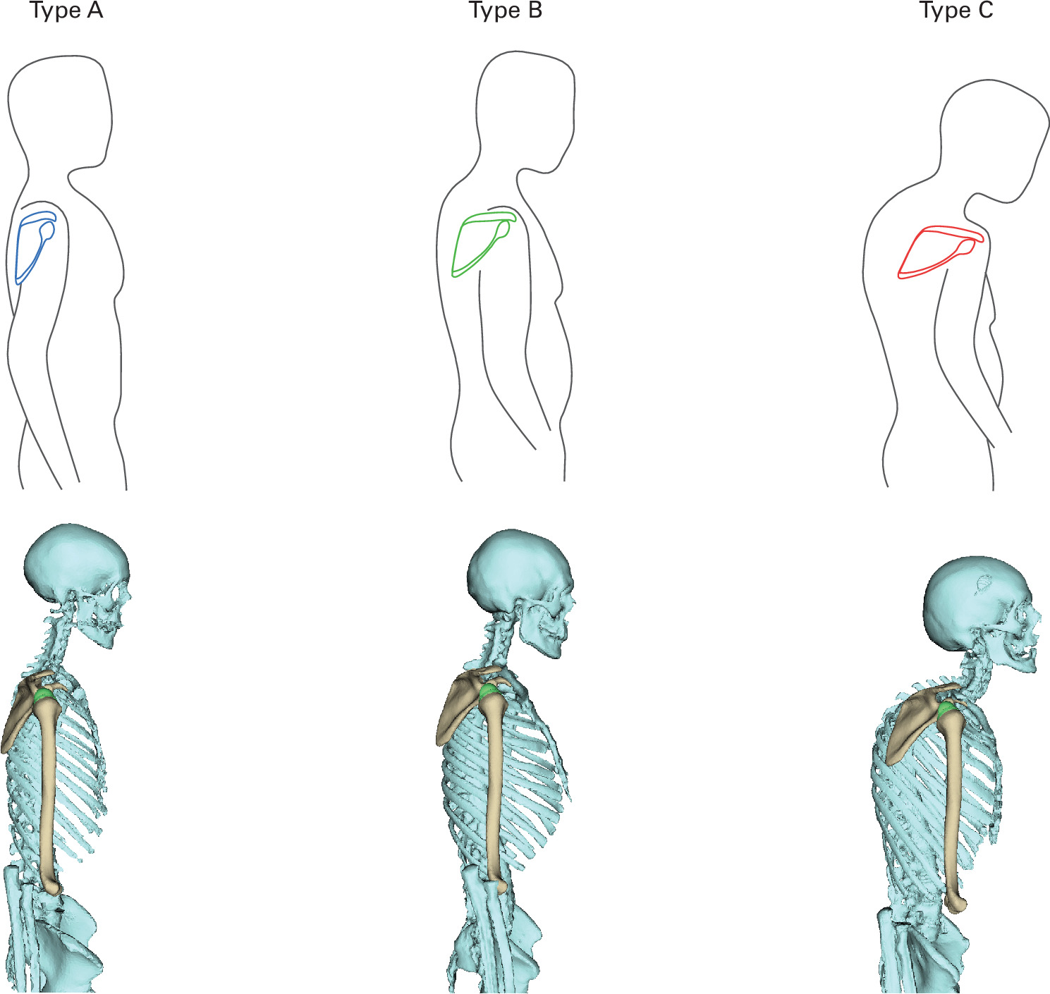 Fig. 1 
          Three posture types, based on previously established values for scapulothoracic orientation.8 Type A shows an upright posture with retracted scapulae, while type C presents with advanced thoracic kyphosis and subsequent increase in scapula internal rotation, anterior tilt, downward, rotation, protraction, and drooping. Type B constitutes an average patient. The statistical shoulder shape model of humerus and scapula fitted into different posture types is shown below each type.
        