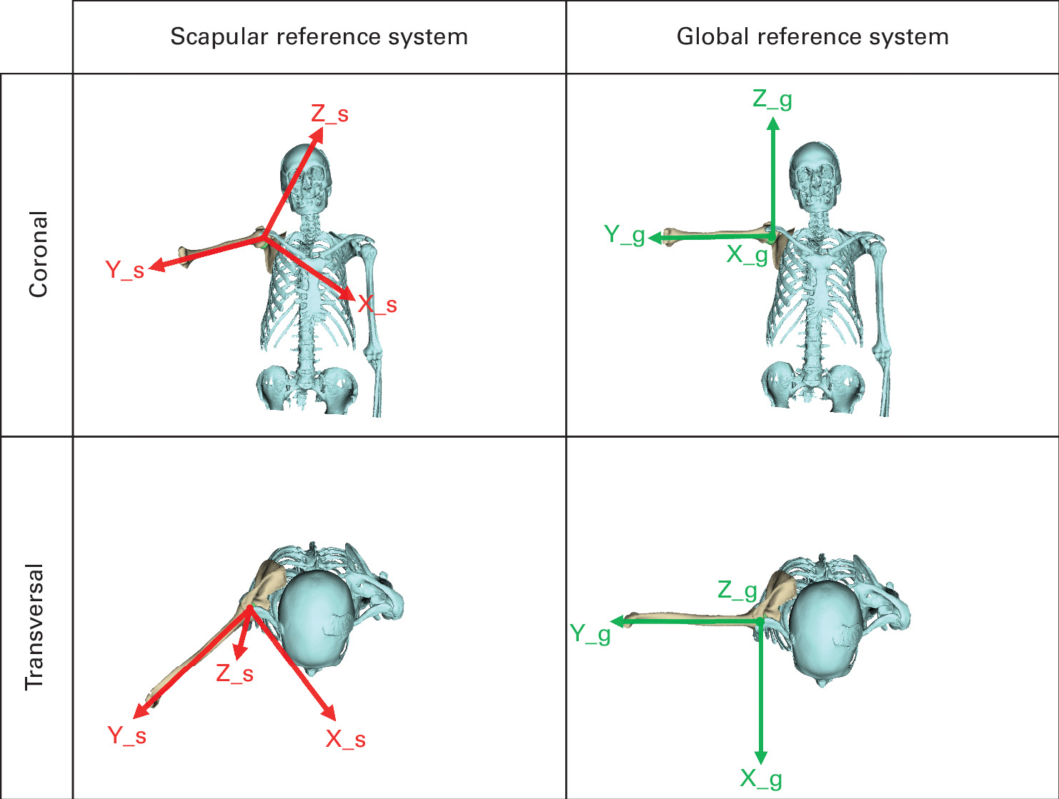 Fig. 2 
            Illustration of scapular and global reference systems for abduction kinematic plane of the humerus applied in a type C patient in a coronal and transverse view. In all commercially available software, movements are referenced to the scapula, which is considered to be in neutral orientation. This means that an abduction motion is aligned with the scapular axis and not orthogonal to the coronal body axis, as would be the case utilizing a global reference system.
          