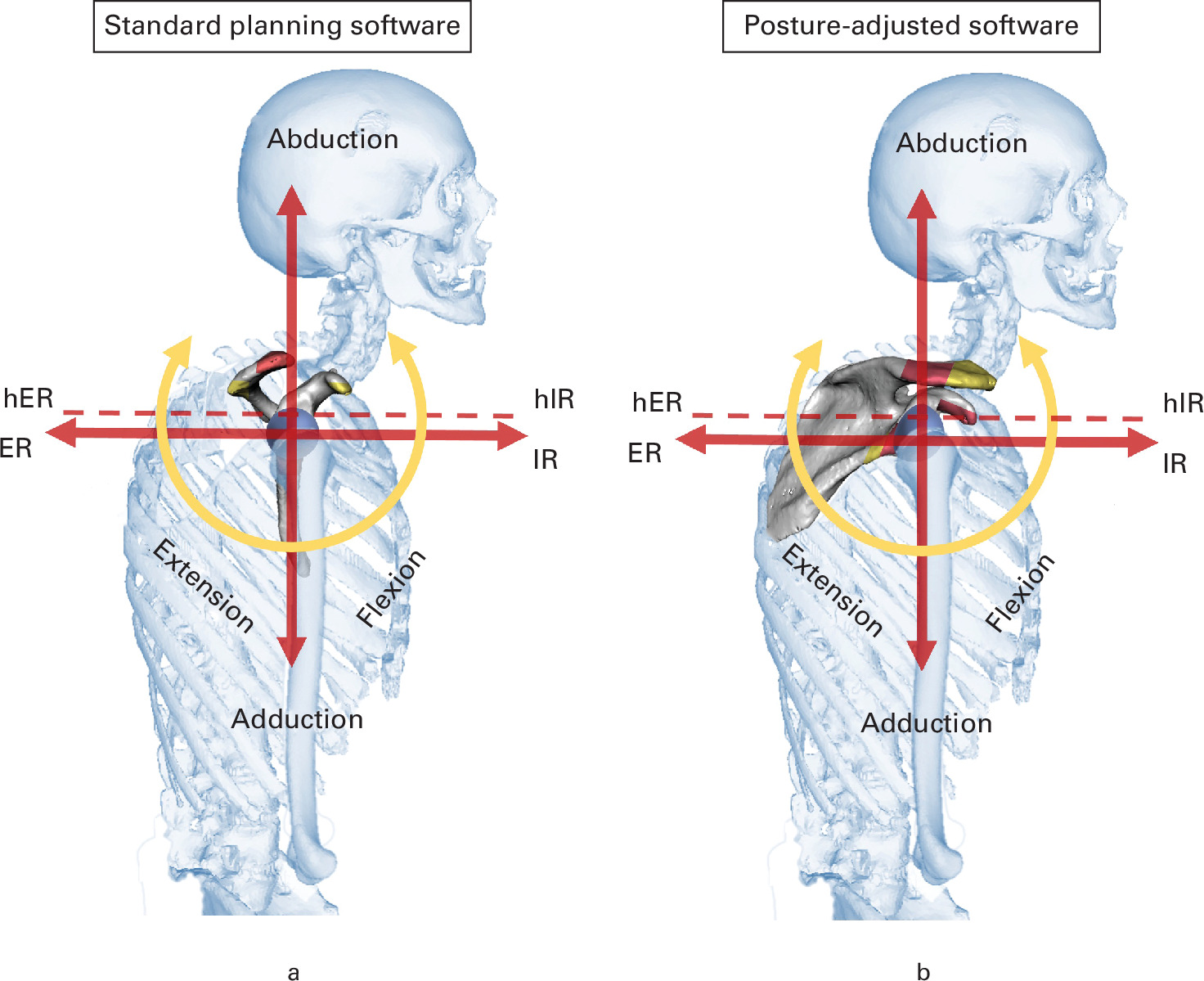 Fig. 7 
          Illustration of range of motion (ROM) simulation in a type C patient using a) a conventional preoperative planning protocol and b) a posture-adjusted protocol. Due to the altered scapulothoracic orientation, simulated mechanical impingement occurs in different areas of the scapula (red and yellow), explaining divergent ROM results between protocol with and without posture adjustment. ER, external rotation; hER, high external rotation; hIR, high internal rotation; IR, internal rotation.
        