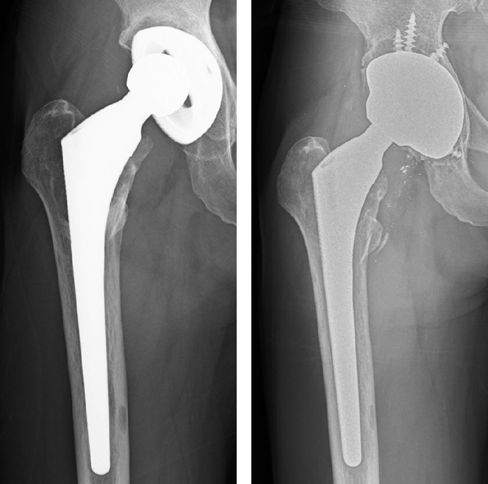 Fig. 3 
          Anteroposterior radiographs of a 61-year-old female who underwent total hip arthroplasty using an Omnifit HA femoral stem (Osteonics, USA). There was evidence of polyethylene wear and aseptic acetabular loosening seven years postoperatively (left side). The stem was well fixed. Revision of acetabular component and liner was performed (right side).
        