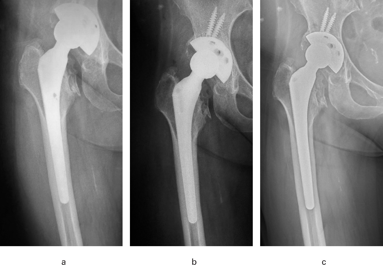 Fig. 4 
          Serial anteroposterior radiographs of a 48-year-old female who underwent total hip arthroplasty using an Omnifit HA femoral stem (Osteonics, USA). The initial surgery was performed for avascular necrosis in 1997. a) One year postoperatively (1998). b) 13 years postoperatively (2010). c) There were no signs of loosening 25 years postoperatively (2022).
        