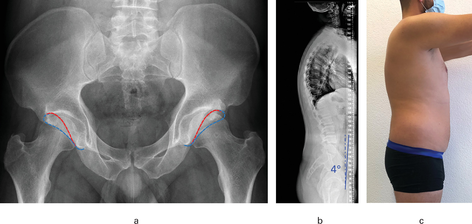 Fig. 1 
          a) An anteroposterior pelvic radiograph of a 30-year-old male with complete acetabular retroversion. The red line indicates the posterior wall and the blue line the anterior wall. b) A standing lateral radiograph shows a normal lumbar lordosis and anterior pelvic tilt of 4° with regard to the anterior pelvic plane. c) A clinical photograph of the patient showing a flat-back aspect.
        