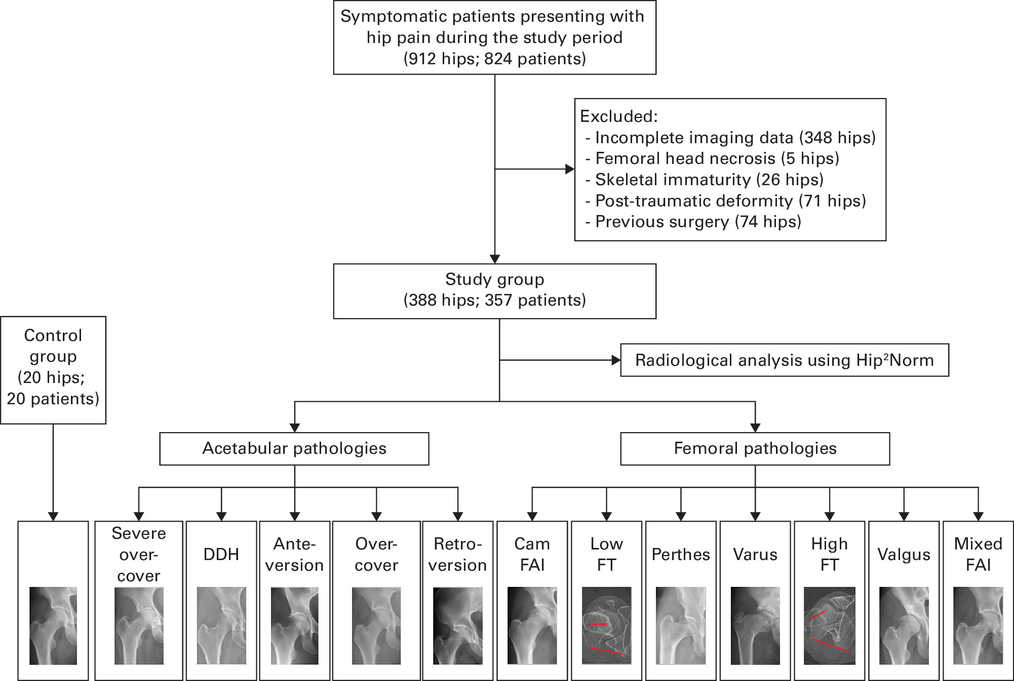 Fig. 2 
          Study flowchart. DDH, developmental dysplasia of the hip; FAI, femoroacetabular impingement; FT, femoral torsion.
        