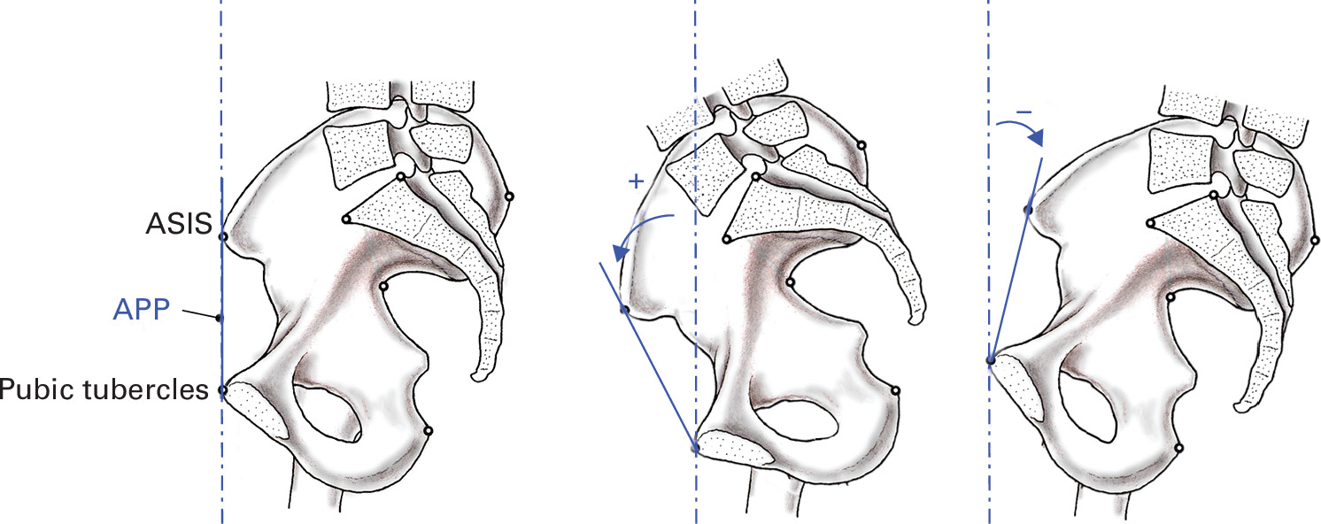 Fig. 3 
          Definition of pelvic tilt (PT) with regard to the anterior pelvic plane (APP). PT is defined as neutral with the APP in a perfectly vertical position (left). Anterior and posterior PT are defined as rotation of the anterior superior iliac spines (ASISs) anteriorly and posteriorly, respectively. When reporting the APP-PT, a positive value indicates anterior PT and a negative value indicates posterior PT.
        