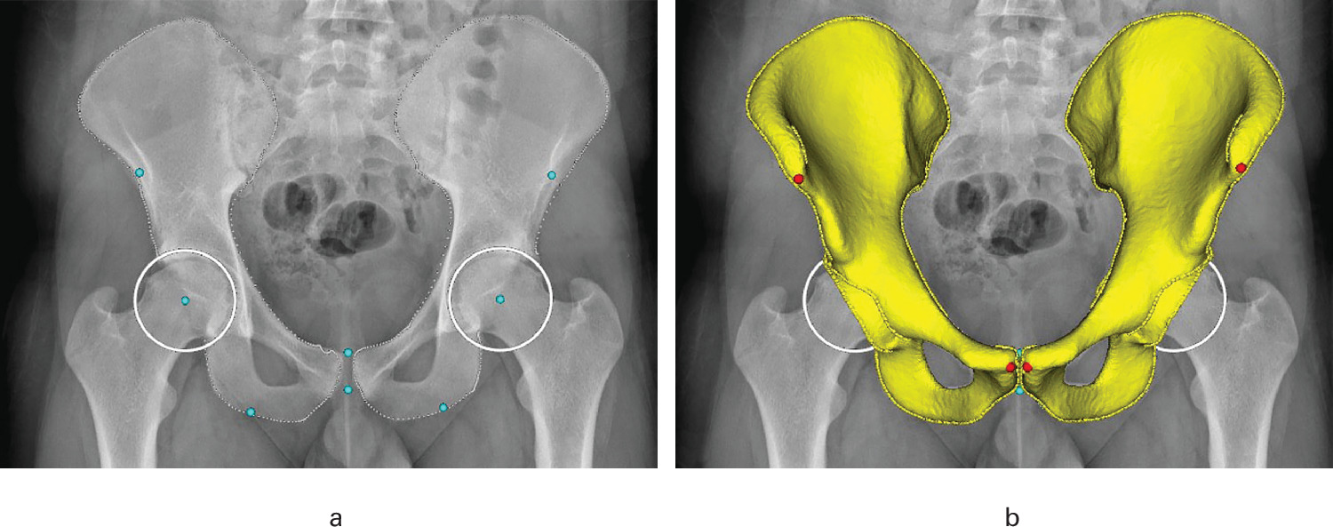 Fig. 4 
          HipRecon’s 2D/3D deformation reconstruction algorithm allowing the transformation of an a) anteroposterior radiograph into a b) patient-specific 3D model of the pelvis.
        