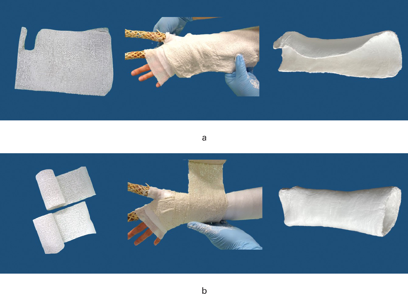 Fig. 1 
          a) Plaster splint. b) Circumferential cast. Synthetic casting, instead of plaster of Paris, was also accepted.
        