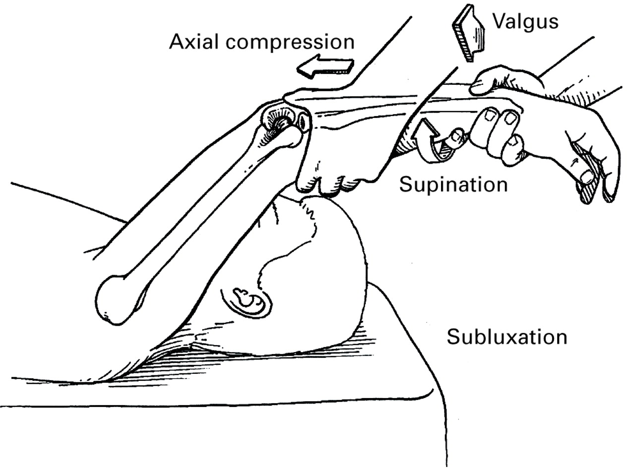 Ligamentous repair and reconstruction for posterolateral rotatory ...