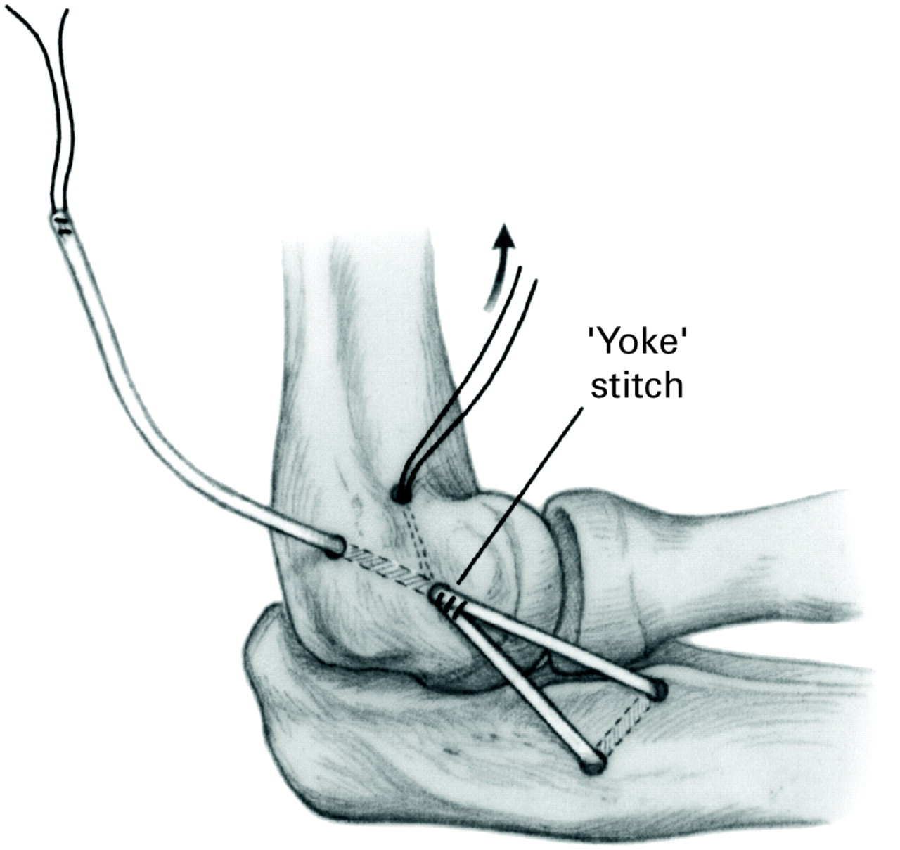 Ligamentous Repair And Reconstruction For Posterolateral Rotatory