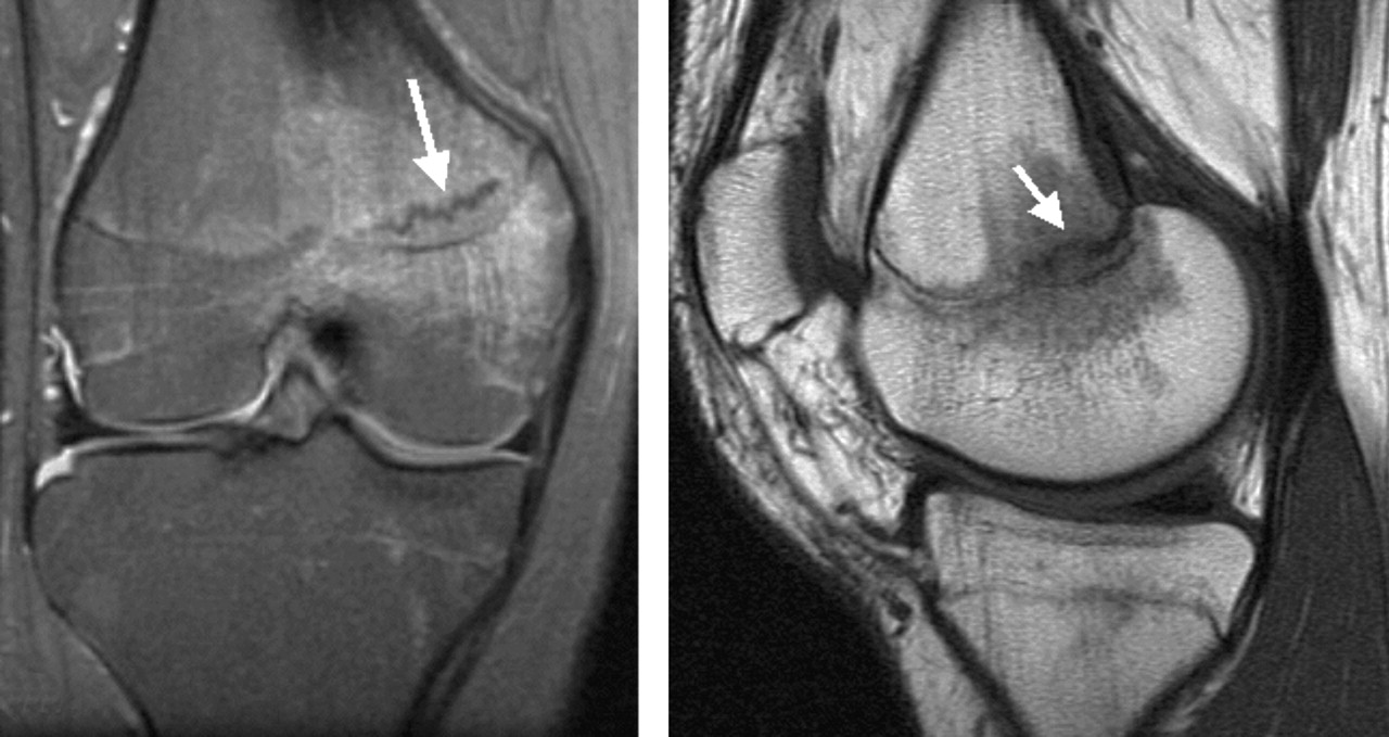 Fatigue injuries of the femur | Bone & Joint