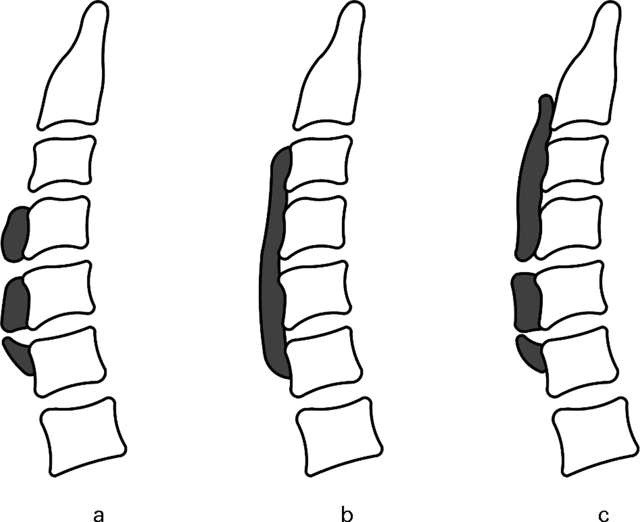 posterior longitudinal ligament