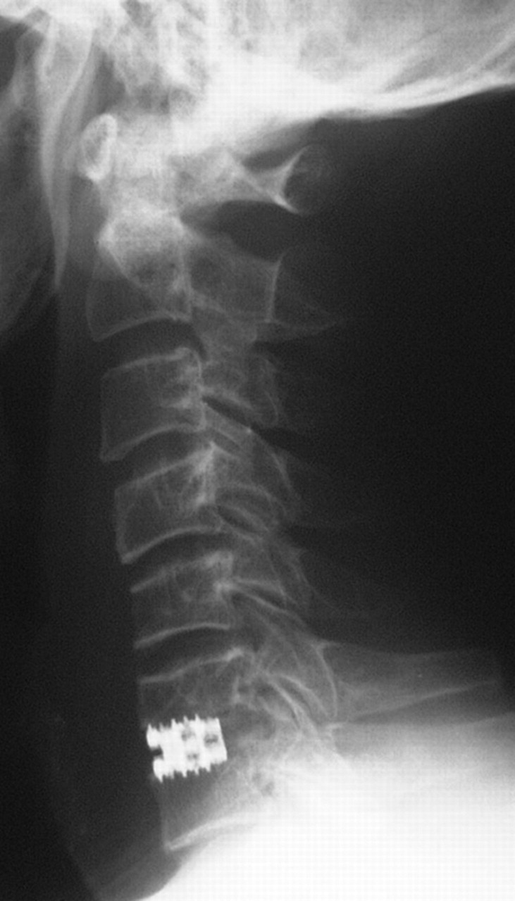 Symptomatic Ossification Of The Anterior Longitudinal Ligament With Stenosis Of The Cervical 3488